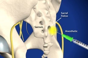 Caudal-Spinal-Epidural-Injection-